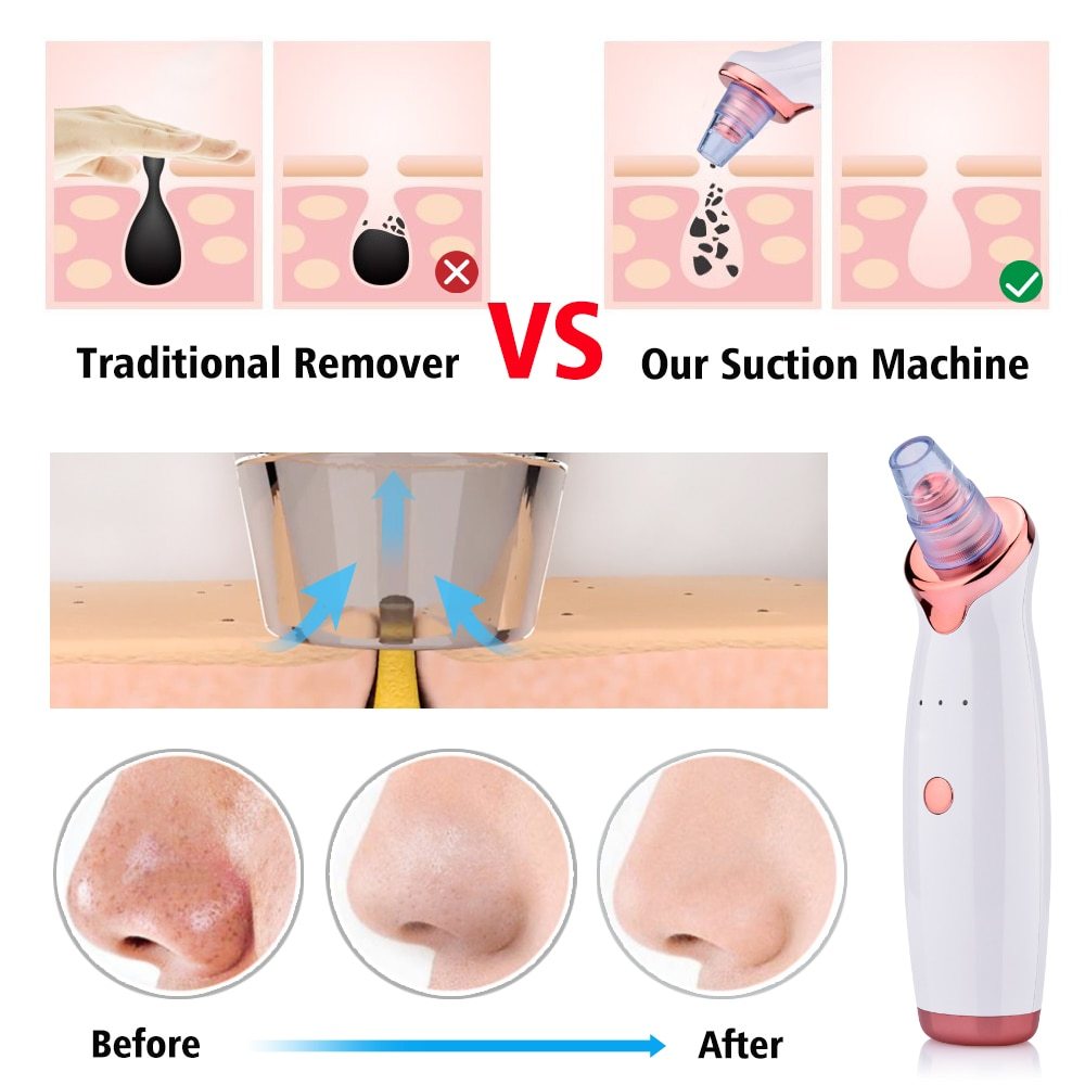 Blommea Electric Blackhead Remover – Deep Pore Cleanse & Skin Renewal